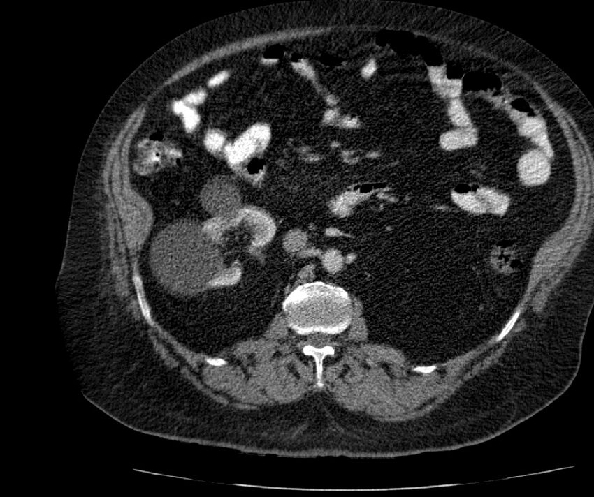 Nephroptosis with inguinal hernia containing perirenal fat (Radiopaedia 56632-63391 C 152).jpg