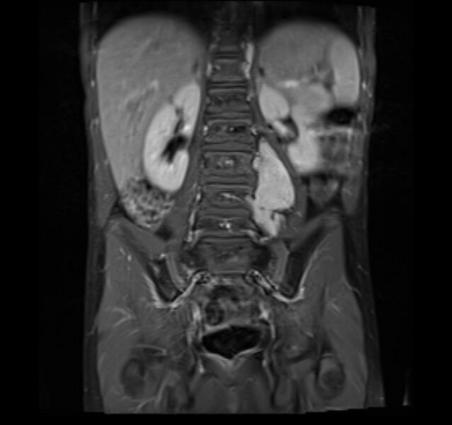 File:Neuroblastoma (Radiopaedia 6010-7518 Coronal T1 fat sat 3).jpg