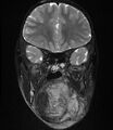 Neurofibromatosis type 1 (Radiopaedia 6954-8063 Coronal T2 3).jpg