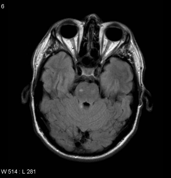 File:Neurosarcoidosis (Radiopaedia 10930-17204 Axial FLAIR 6).jpg