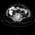 Non-Hodgkin lymphoma (Radiopaedia 84008-99238 A 35).jpg