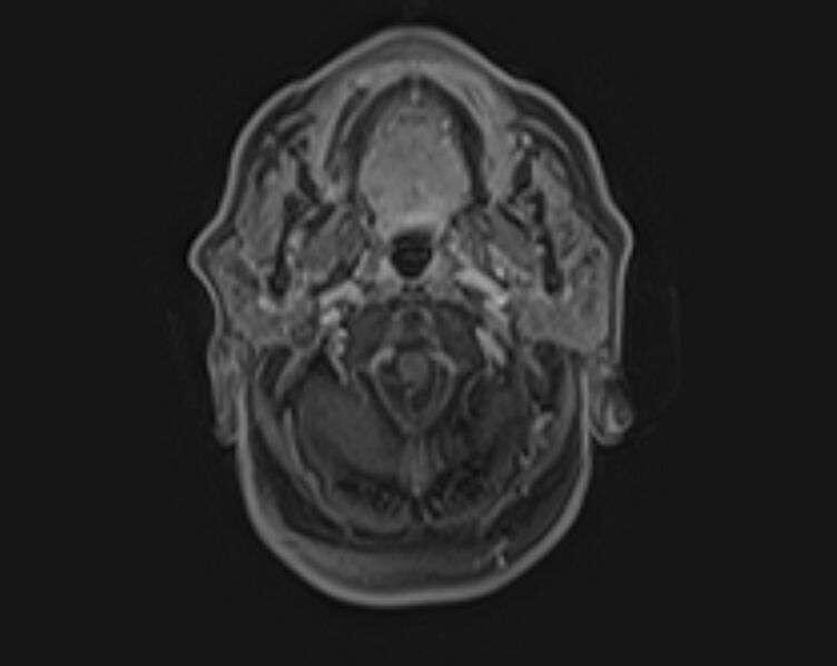 File:Non-Hodgkin lymphoma - parotid gland (Radiopaedia 71531-81890 E 15).jpg