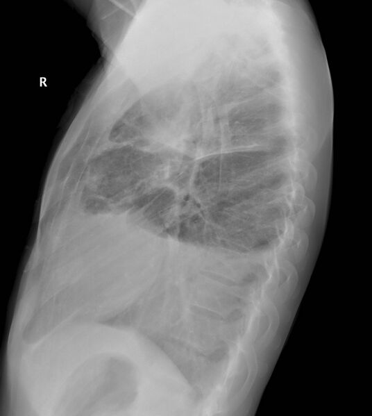 File:Non-Hodgkin lymphoma involving lung (Radiopaedia 29094-29472 Lateral 1).jpg