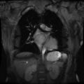 Non-compaction of the left ventricle (Radiopaedia 38868-41062 Coronal SSFP 2D FS 4).jpg