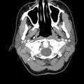 Normal CT of the neck (Radiopaedia 14575-14500 Axial C+ 21).jpg
