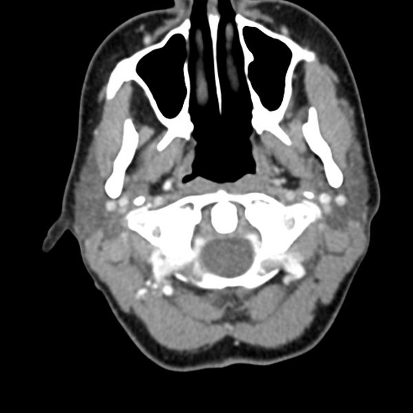 File:Normal CT of the neck (Radiopaedia 14575-14500 Axial C+ 21).jpg