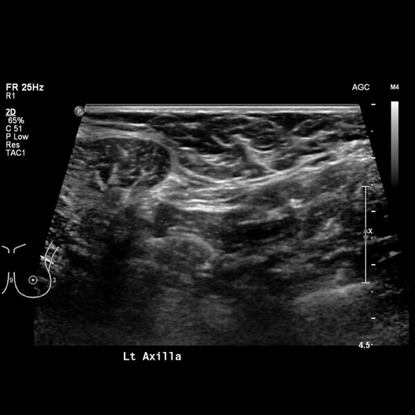 File:Normal breast mammography (tomosynthesis) and ultrasound (Radiopaedia 65325-74354 Left breast 16).jpeg