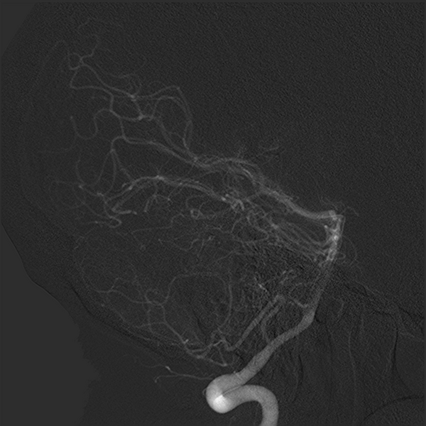 File:Normal cerebral angiogram (four vessel DSA) (Radiopaedia 41708-44649 R 10).png