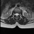 Normal cervical and thoracic spine MRI (Radiopaedia 35630-37156 H 2).png