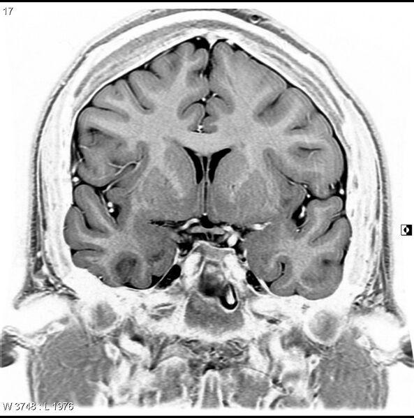File:Normal coronal brain (Radiopaedia 6676-7910 B 17).jpg