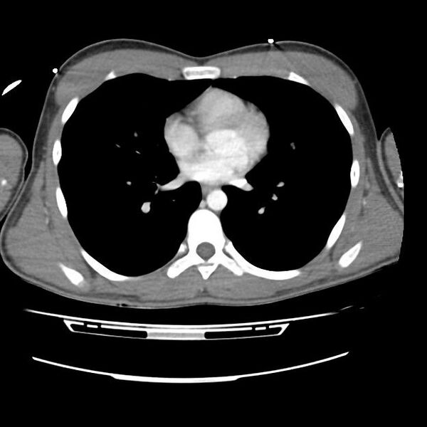 File:Normal dual-phase trauma CT chest,abdomen and pelvis (Radiopaedia 48092-52899 A 32).jpg