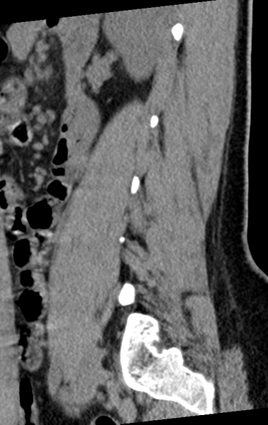 File:Normal lumbar spine CT (Radiopaedia 46533-50986 C 25).png