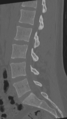 Normal lumbar spine CT (Radiopaedia 46533-50986 Sagittal bone window 46).png