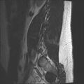 Normal lumbar spine MRI (Radiopaedia 47857-52609 Sagittal T2 19).jpg