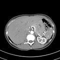 Normal multiphase CT liver (Radiopaedia 38026-39996 B 20).jpg
