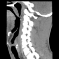 Normal trauma cervical spine (Radiopaedia 41017-43760 B 11).png