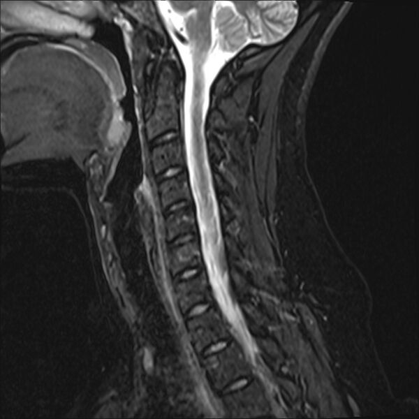 File:Normal trauma cervical spine MRI (Radiopaedia 32130-33071 Sagittal STIR 6).jpg