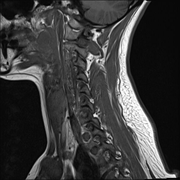 File:Normal trauma cervical spine MRI (Radiopaedia 32130-33071 Sagittal T1 13).jpg