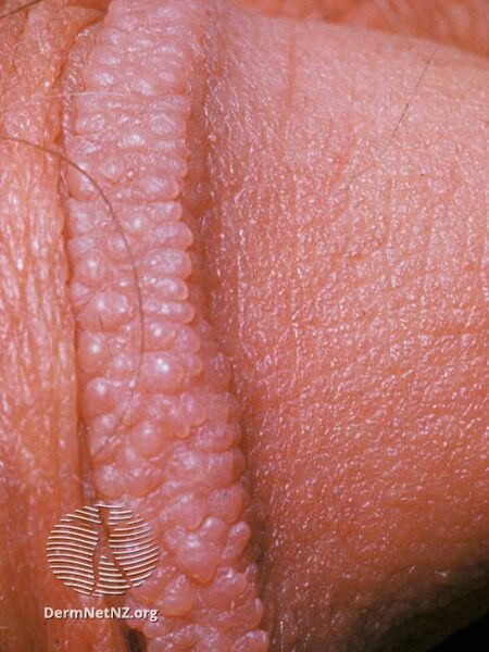 File:Pearly penile papules (DermNet NZ penile-pearly-papules-03).jpg