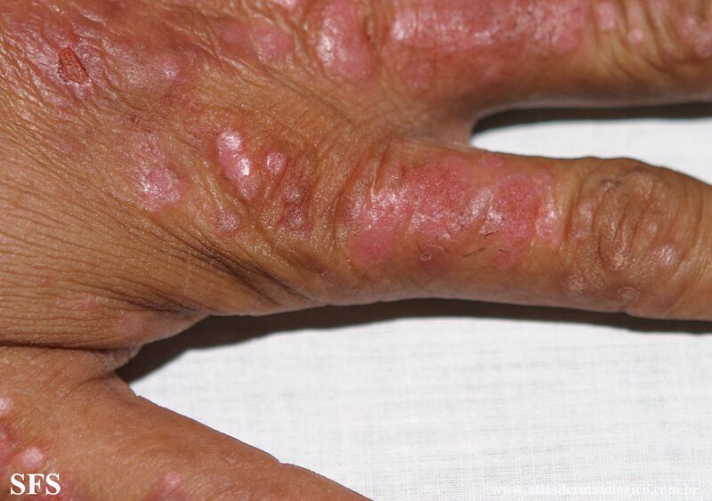 File:Psoriasis (Dermatology Atlas 125).jpg