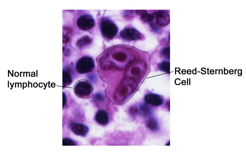 File:Source (DermNet NZ Reed-Sternberg-lymphocyte-nci-vol-7172-300).jpg