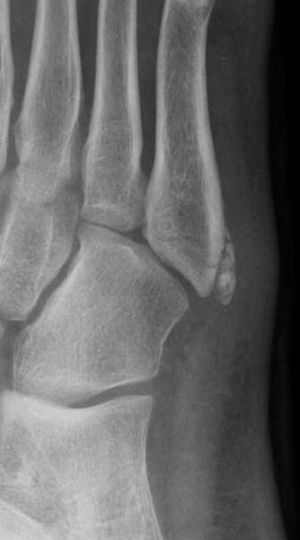 File:5th metatarsal fracture and normal apophysis (Radiopaedia 13196-44529 Oblique 1).jpg