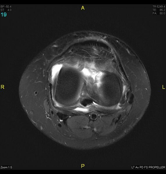 File:ACL mucoid degeration with cystic changes (Radiopaedia 48428-53341 Axial PD fat sat 16).jpg