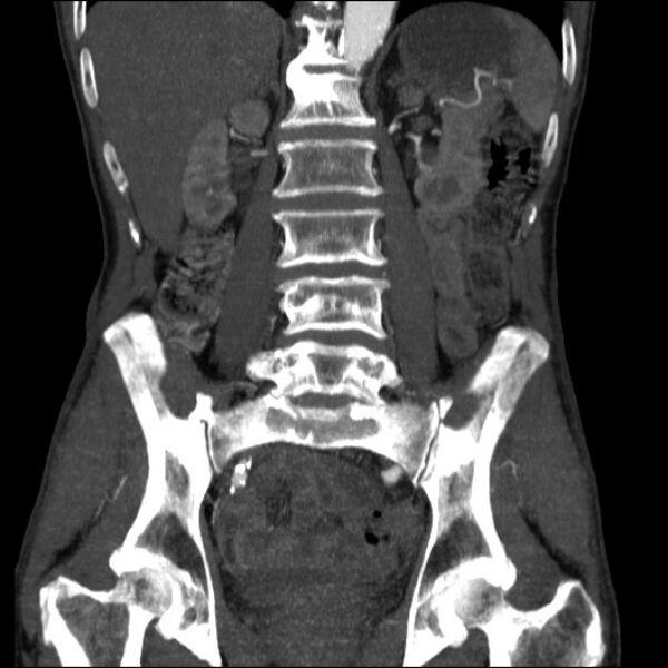 File:Abdominal aortic aneurysm (Radiopaedia 23703-23856 Coronal C+ arterial phase 20).jpg