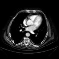 Abdominal aortic aneurysm (Radiopaedia 25855-26001 Axial C+ arterial phase 2).jpg