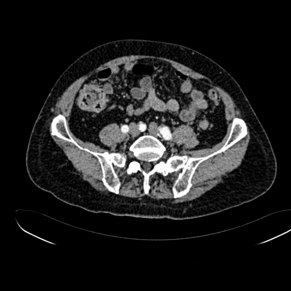 File:Abdominal aortic aneurysm (Radiopaedia 75131-86203 Axial C+ arterial phase 33).jpg
