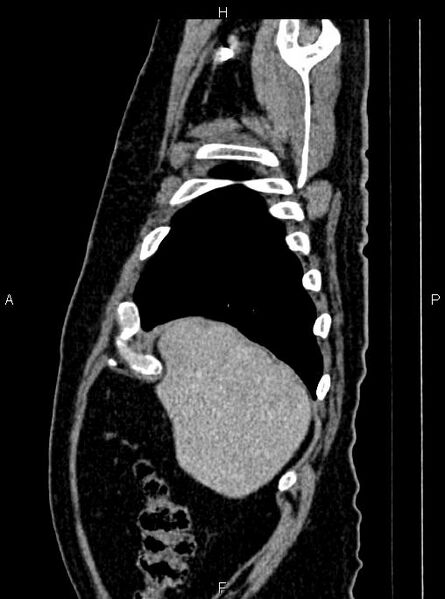File:Abdominal aortic aneurysm (Radiopaedia 83094-97462 Sagittal renal cortical phase 20).jpg