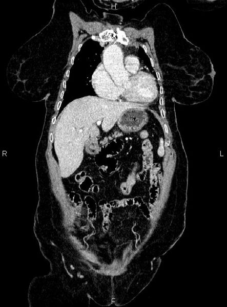 File:Abdominal aortic aneurysm (Radiopaedia 85063-100606 Coronal C+ arterial phase 11).jpg
