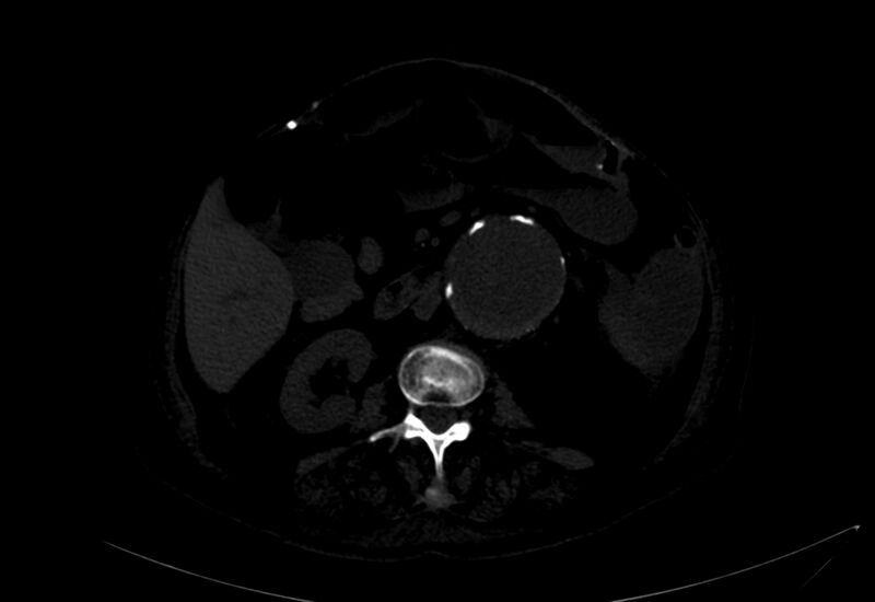 File:Abdominal aortic aneurysm - impending rupture (Radiopaedia 19233-19246 B 14).jpg