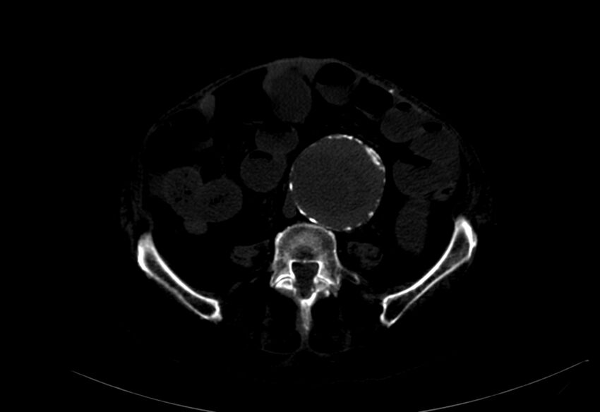 Abdominal aortic aneurysm - impending rupture (Radiopaedia 19233-19246 B 30).jpg