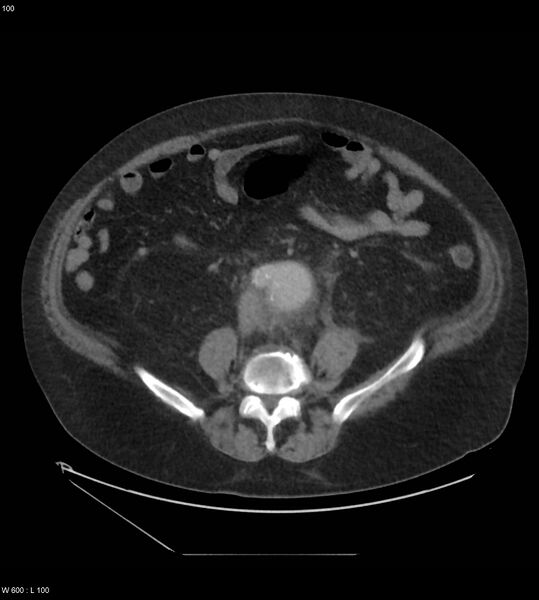 File:Abdominal aortic aneurysm with intramural hematoma then rupture (Radiopaedia 50278-55631 Axial C+ arterial phase 91).jpg