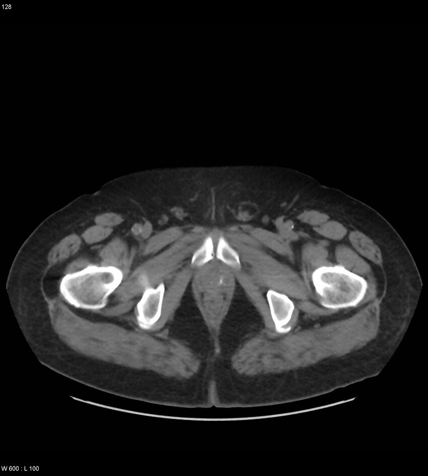 Abdominal aortic aneurysm with intramural hematoma then rupture (Radiopaedia 50278-55631 Axial non-contrast 124).jpg