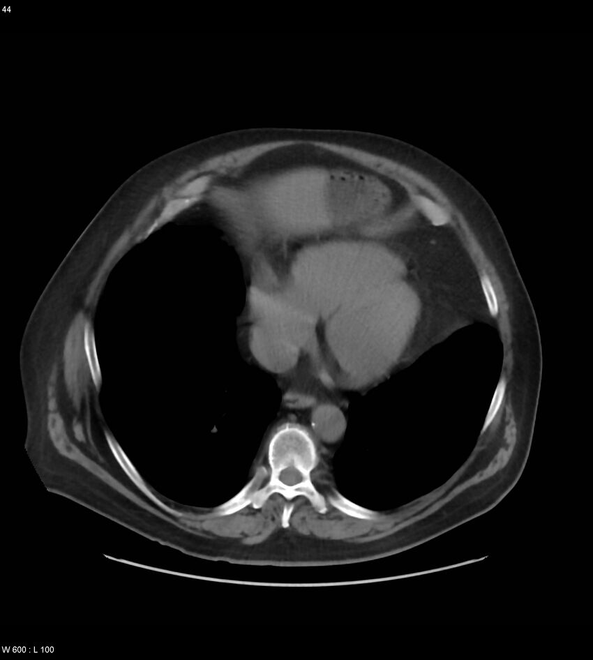 Abdominal aortic aneurysm with intramural hematoma then rupture (Radiopaedia 50278-55631 Axial non-contrast 40).jpg