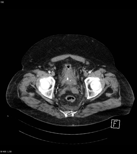 File:Abdominal aortic aneurysm with intramural hematoma then rupture (Radiopaedia 50278-55632 Axial C+ arterial phase 155).jpg