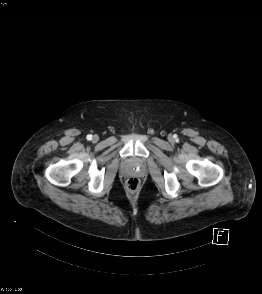 Abdominal aortic aneurysm with intramural hematoma then rupture (Radiopaedia 50278-55632 Axial C+ arterial phase 170).jpg
