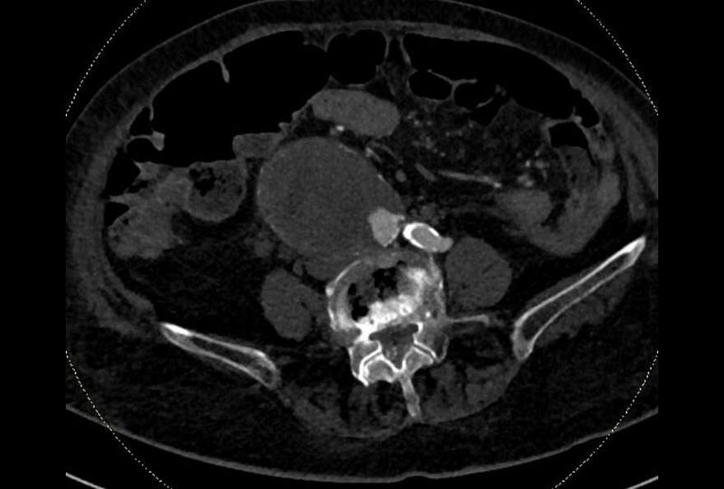 File:Abdominal aortic aneurysm with thrombus fissuration (Radiopaedia 73192-83919 Axial C+ arterial phase 137).jpg