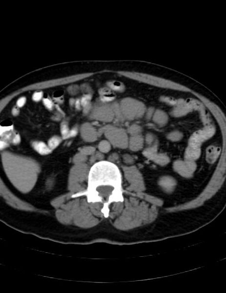 File:Abdominal lymphoma - with sandwich sign (Radiopaedia 53486-59492 Axial C+ portal venous phase 26).jpg