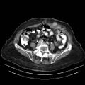 Abdominal wall recurrence after colorectal resection for cancer (Radiopaedia 23444-23523 Axial C+ portal venous phase 24).jpg