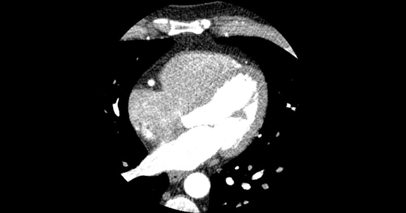 File:Aberrant left main coronary artery (ALMCA) arising from the right sinus with interarterial course (Radiopaedia 63251-71814 Axial C+ arterial phase 104).JPG