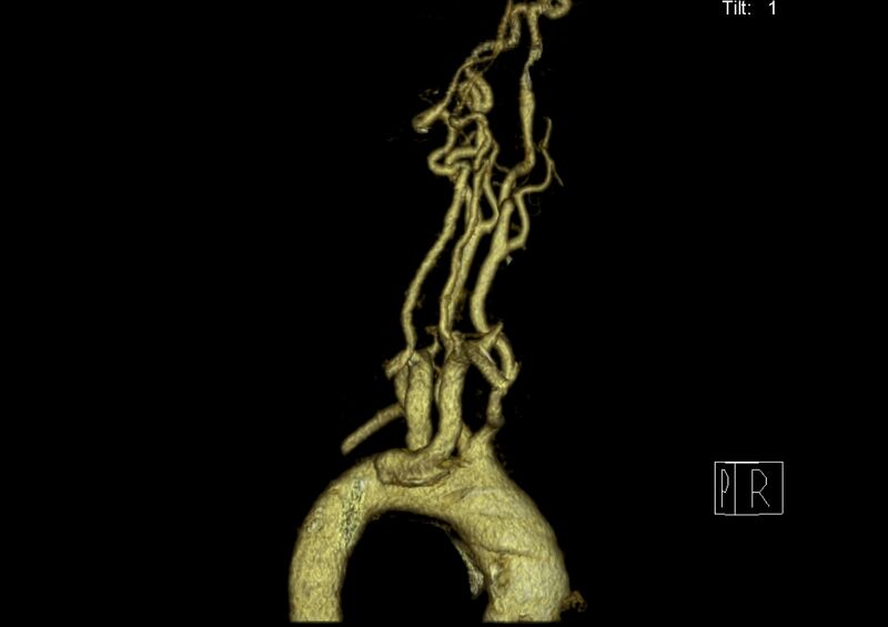 File:Aberrant right subclavian artery (Radiopaedia 19283-19294 3D reconstruction C+ arterial phase 28).jpg