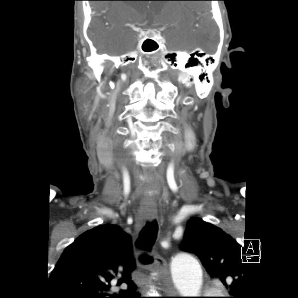 File:Acute ICA ischemic penumbra due to high-grade CCA stenosis (CT perfusion) (Radiopaedia 72038-82530 Coronal C+ arterial phase 22).jpg