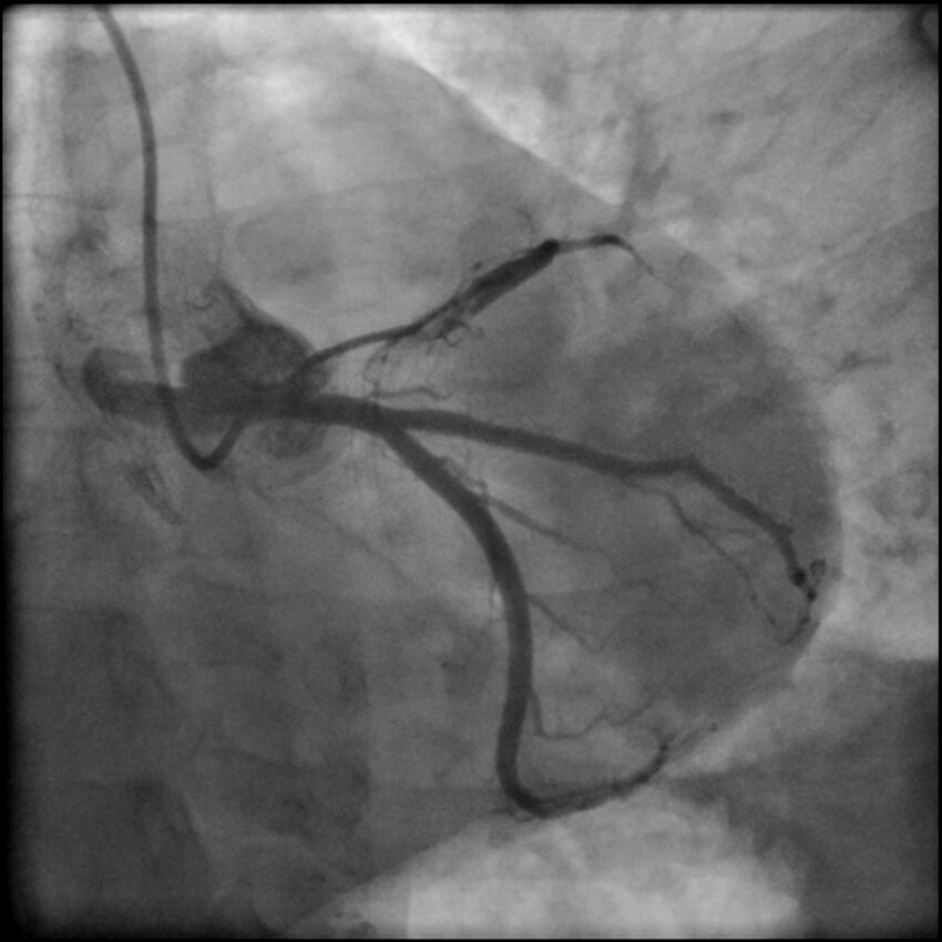 Acute anteroseptal myocardial infarction (Radiopaedia 68409-77946 LAO caudal (spider view) LAD and CX 26).jpg