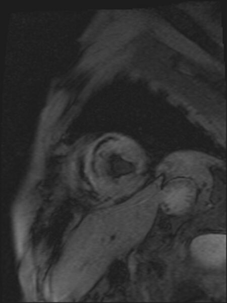 File:Acute anteroseptal myocardial infarction (Radiopaedia 68409-77947 Short axis Gradient Echo 1).jpg