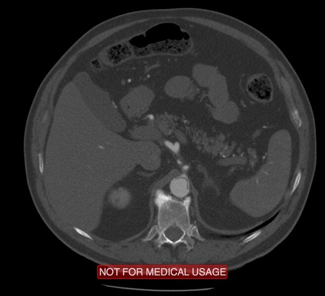 File:Acute aortic dissection - Stanford type A (Radiopaedia 40661-43285 Axial C+ arterial phase 89).jpg