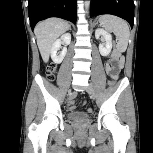 File:Acute appendicitis (Radiopaedia 27049-27227 Coronal C+ portal venous phase 34).jpg