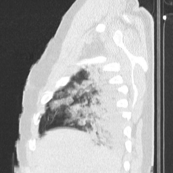 File:Acute aspiration pneumonitis (Radiopaedia 33605-34703 Sagittal lung window 17).jpg